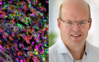 Ductal Carcinoma in Situ: When Cancer isn’t Really Cancer